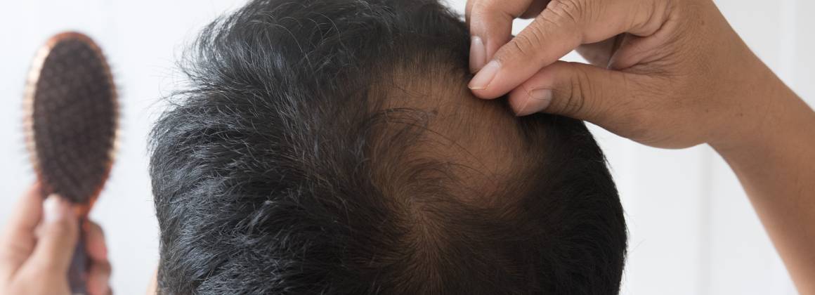 Was ist die Ursache für dünner werdendes Haar und Haarausfall?