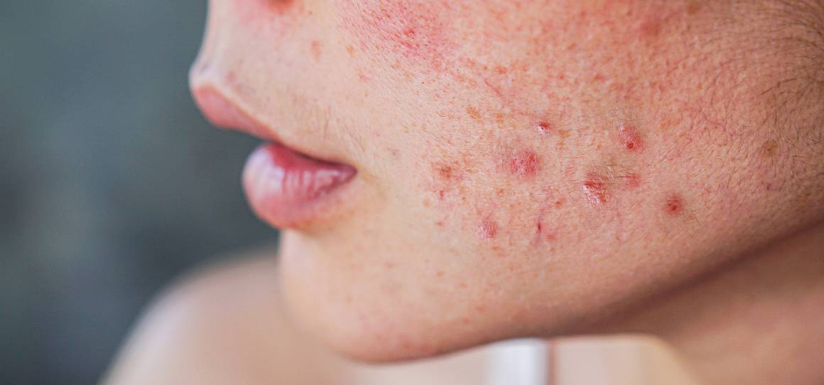 Wie werden Dermatologen Akne los?