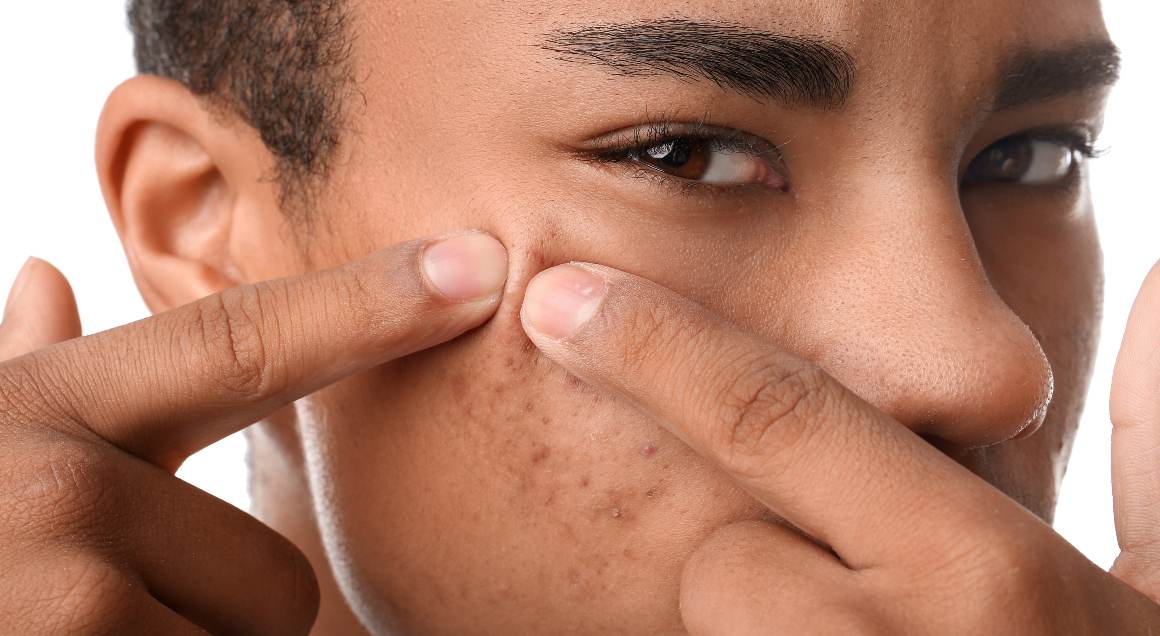Was sind die 2 häufigsten Arten von Akne?