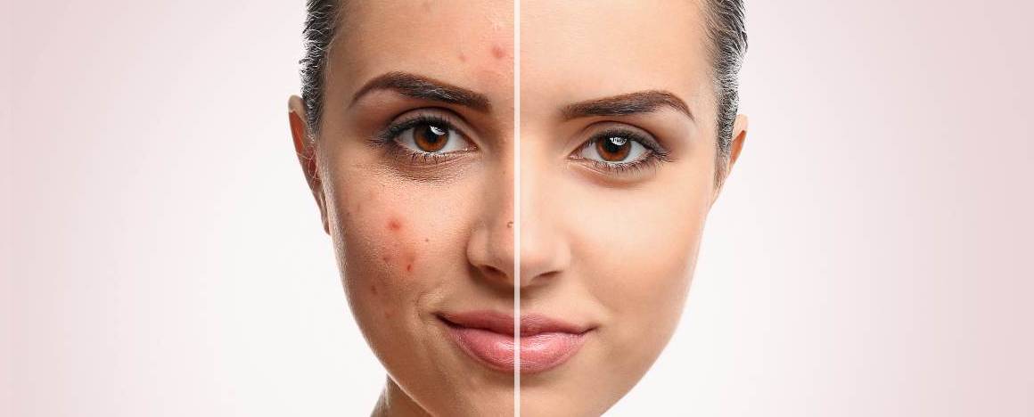 Verschlimmert das Waschen Ihres Gesichts die Akne?