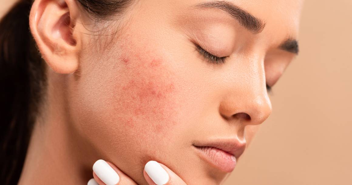 What Kills Acne Bacteria