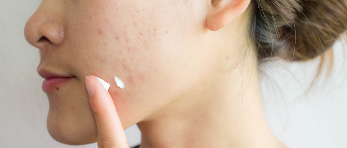 Should You Pop a Pimple