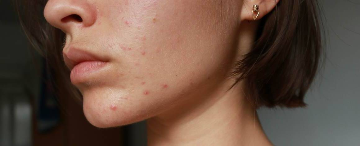 How do I know if my acne is hormonal or stress