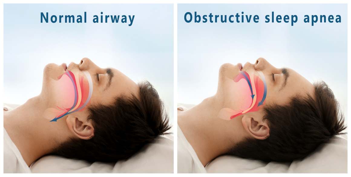 Opzioni di trattamento per l'apnea ostruttiva del sonno