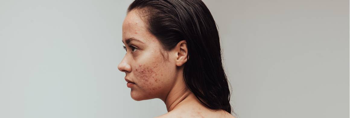 L'acne può scomparire in modo naturale