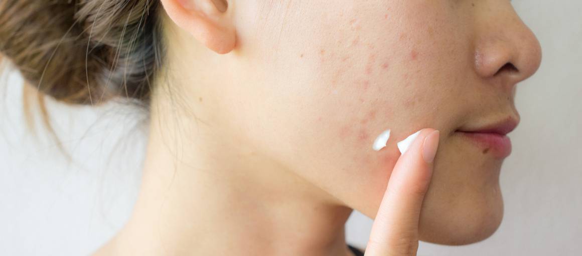 Come posso prevenire l'acne in modo naturale