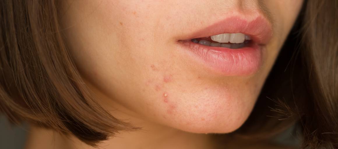 Quali alimenti aiutano a combattere l'acne?