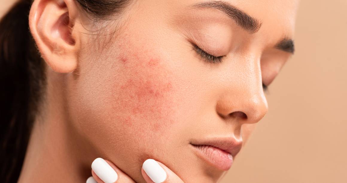 Cosa uccide i batteri dell'acne