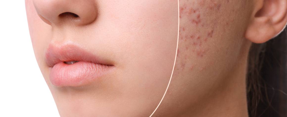 Qual è la differenza tra acne e brufoli?