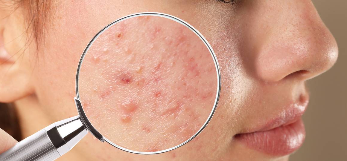 Perché è così difficile liberarsi dell'acne?