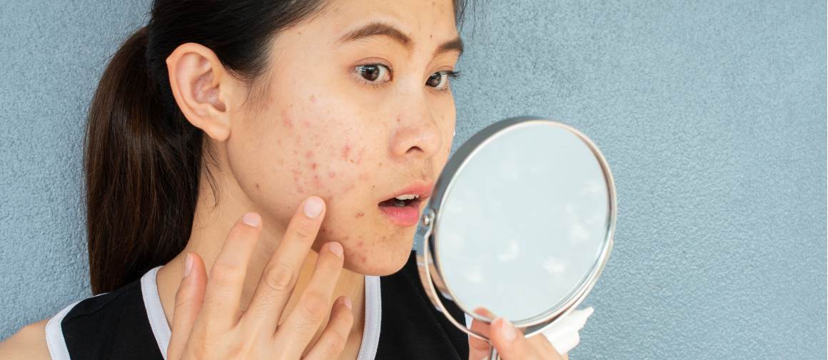 L'acne è causata dall'ansia?