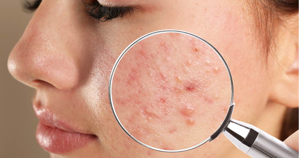 Qual è la differenza tra brufoli e acne?