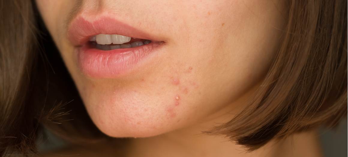 Cosa causa l'acne sul mento