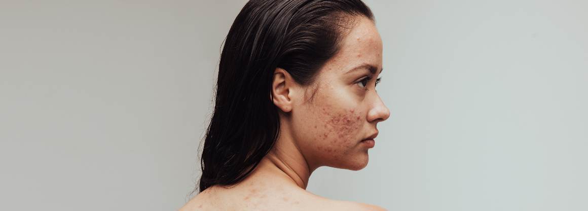 Quali alimenti causano l'acne I 9 principali alimenti che provocano l'acne