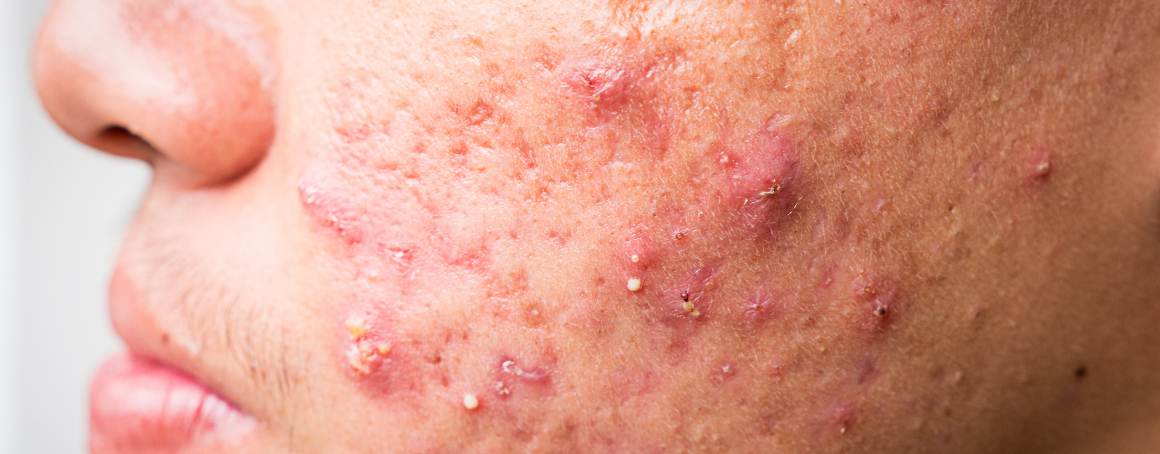 Quali sono gli ultimi stadi dell'acne
