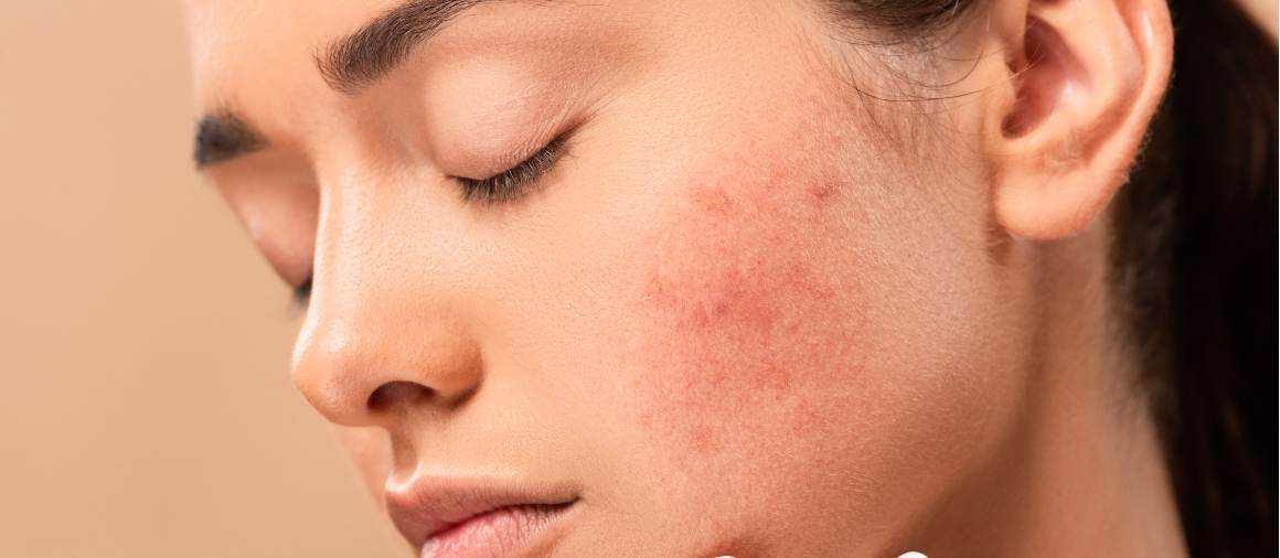 Qual è il tipo di acne più difficile da trattare?
