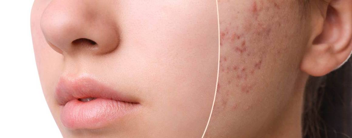 La mancanza di sonno causa l'acne