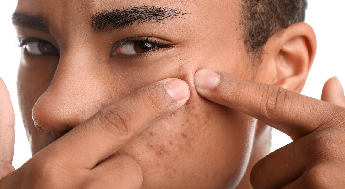 Cosa scatena l'acne cistica