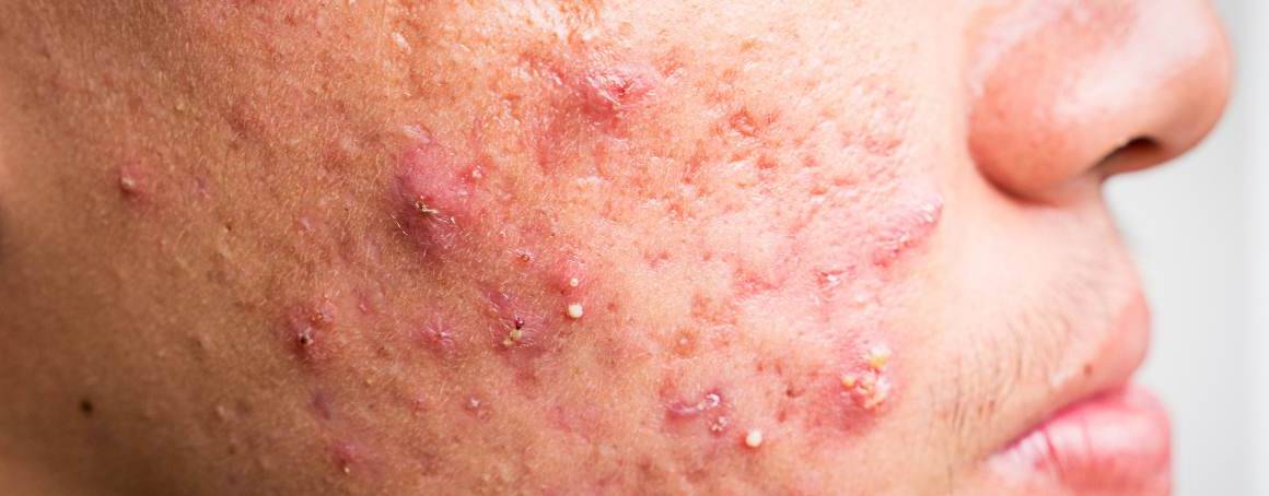 Quali sono i cibi spazzatura per l'acne