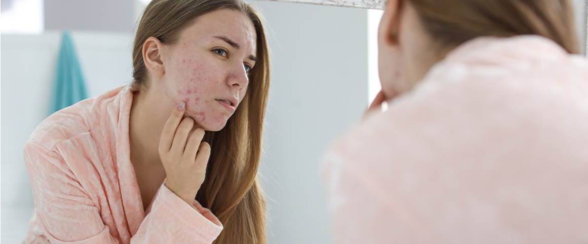 L'acne ritorna dopo la doxiciclina