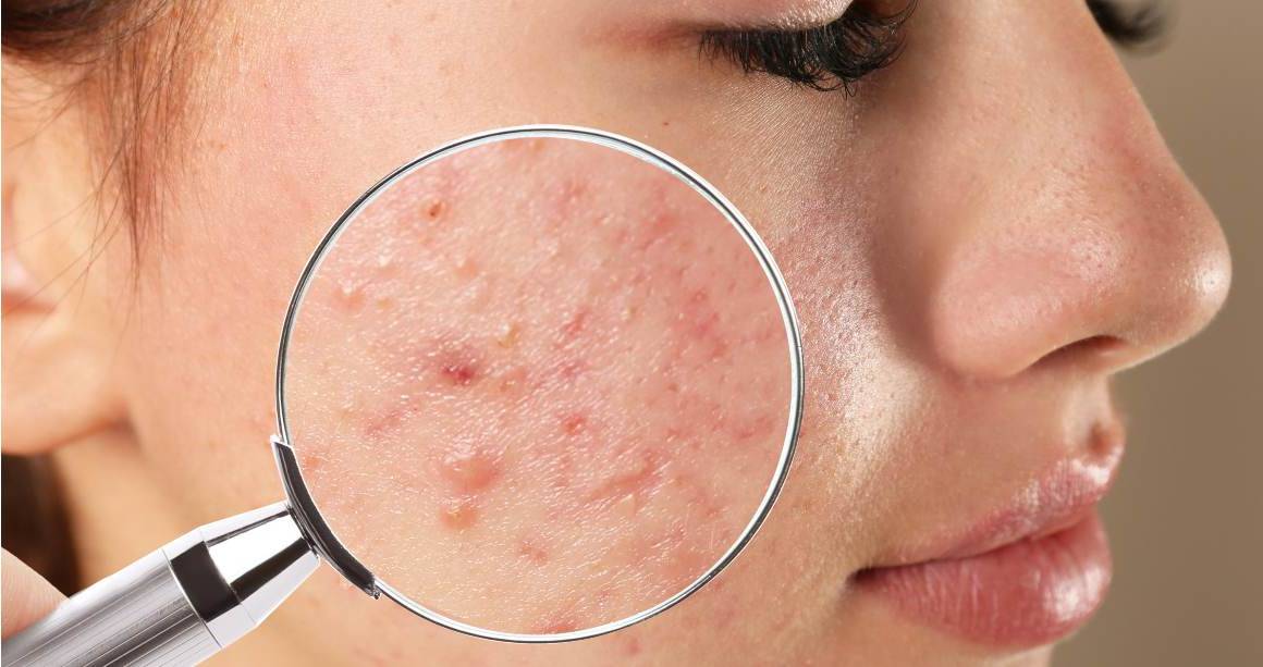 Quanto tempo ci vuole per eliminare completamente l'acne?