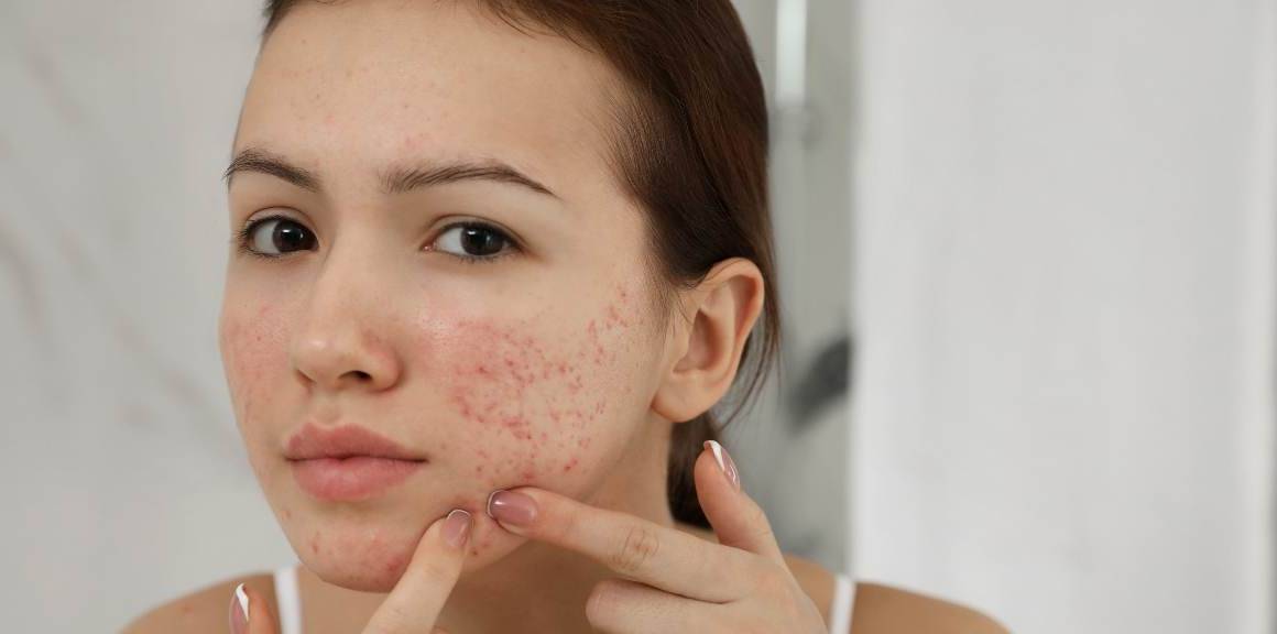 I sorprendenti benefici dell'acne
