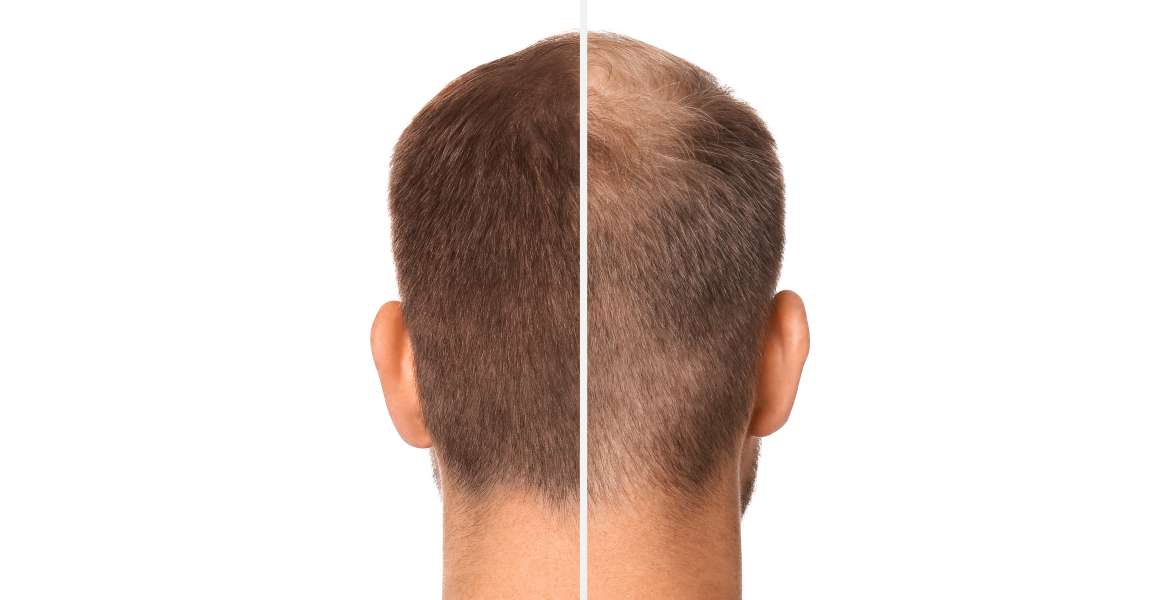 Omega discount 3 hair