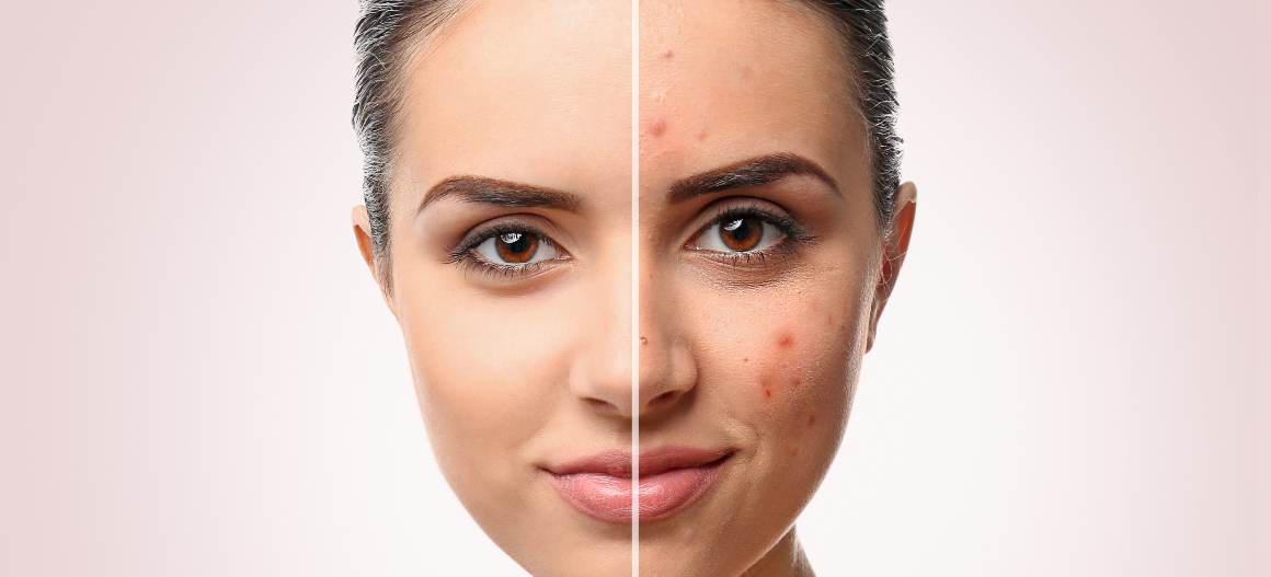 Quali sono i 4 gradi dell'acne?