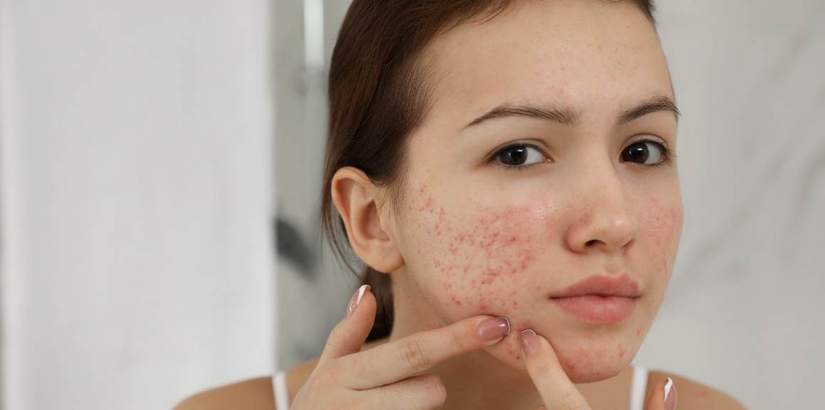 A che età cessa l'acne degli adulti?