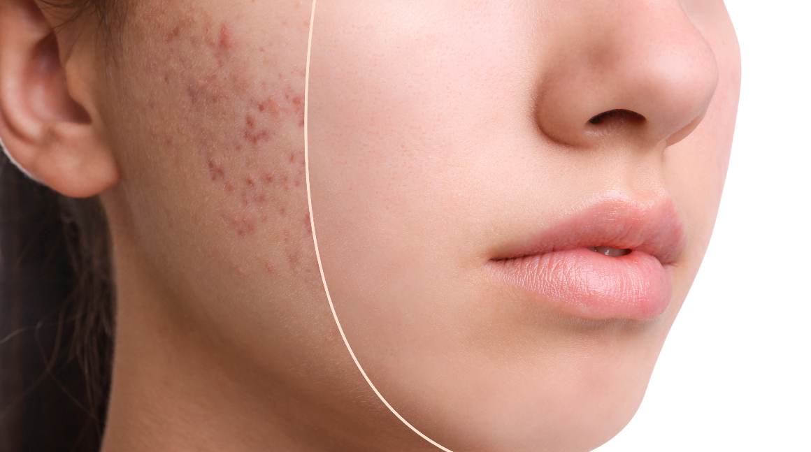Quali sono le 5 cause dell'acne?