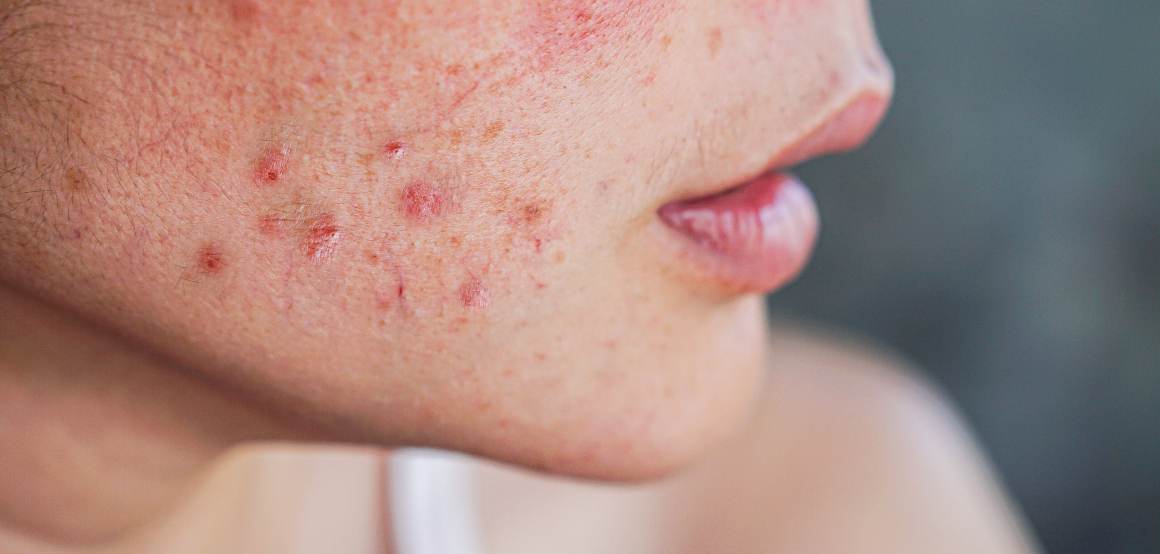 Why is My Acne Getting Worse?