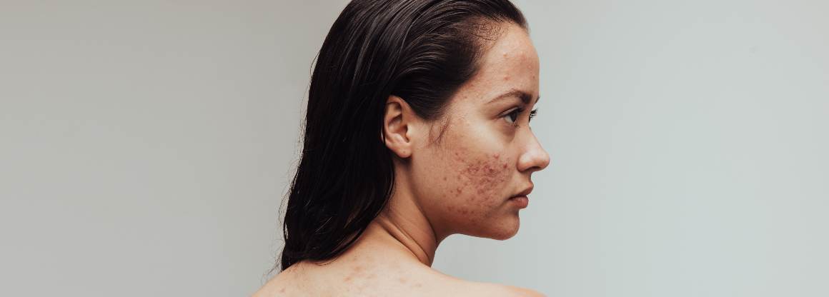 What Foods Cause Acne? The Top 9 Acne-Triggering Foods
