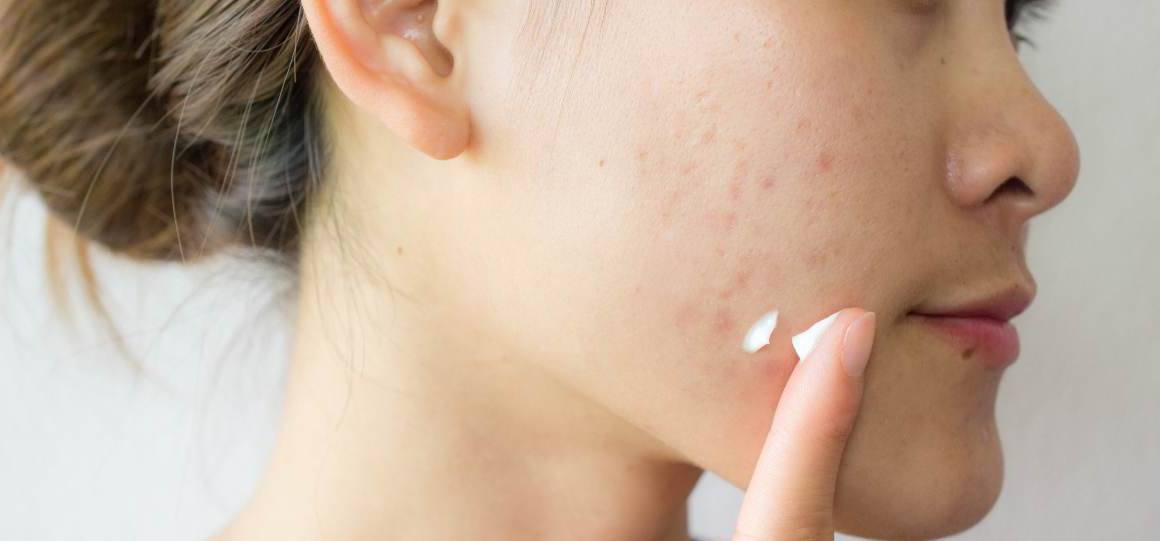 Does Sugar Cause Acne?