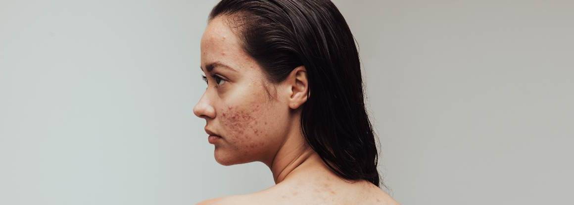 La disidratazione può causare l'acne?