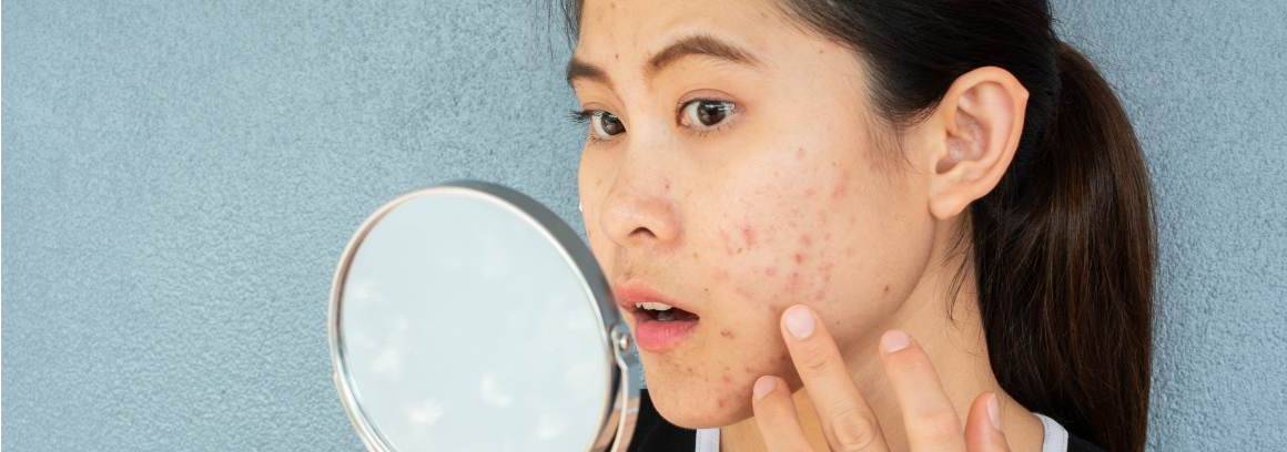 A che età l'acne è peggiore?
