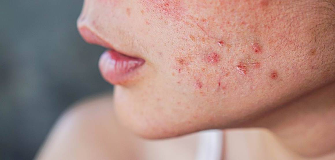 Does acne mean you age slower?