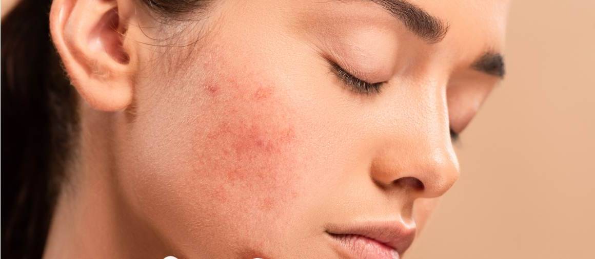 Was verschreiben Dermatologen normalerweise gegen Akne?