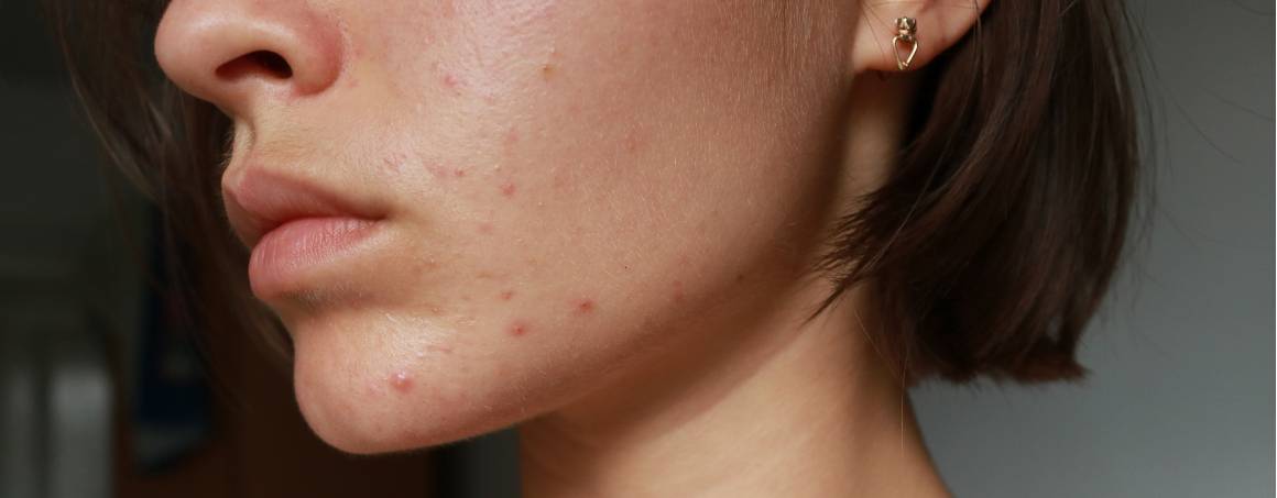 Does acne mean you have a weak immune system