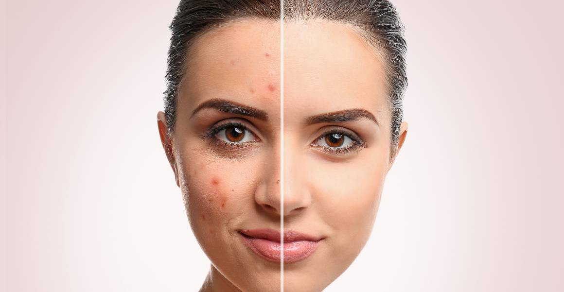 What is the Main Cause of Acne