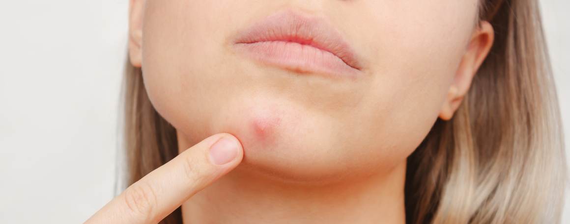 What Happens to the Pus in a Pimple If You Don't Pop It